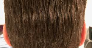 Im zeitraum von drei bis fünf monaten nach der haarverpflanzung beginnt die neubildung der haare bzw. Haartransplantation Spenderbereich Wann Heilt Der Bereich Komplett Ab