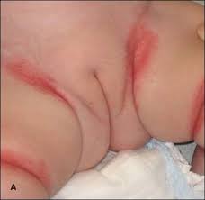 Image result for diaper dermatitis