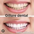 Teeth whitening in indore pipliyahana product image