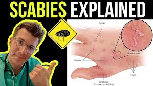 Image result for scabies human children