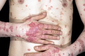 Image result for psoriasis