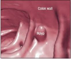 Most of them aren't harmful. Colon Polyps Guide Causes Symptoms And Treatment Options