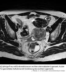 It manifests in three ways; Schonende Diagnose Der Endometriose Mrt Spurt Schleimhautinseln Auf Drg De
