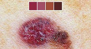 It might be how they look or how they feel. Skin Cancer Photos What Skin Cancer Precancerous Lesions Look Like