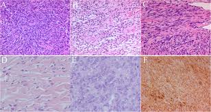 Factors For Postoperative Recurrence Of Orbital Solitary Fibrous Tumor An Analysis Of Long Term Clinical Follow Up Results From A Chinese Tertiary Hospital Bmc Ophthalmology Full Text