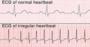 However, not all people with risk factors will have problems. What Is Holter Monitoring Saint Luke S Health System
