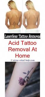Best At Home Tattoo Removal Cream Skin Graft Tattoo Removal How Often Tattoo Removal Tattoo Remova At Home Tattoo Removal Tattoo Removal Cream Tattoo Removal