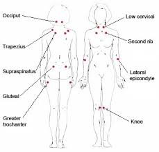 Fibromyalgia Endotext Ncbi Bookshelf