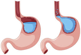 The caffeine in the coffee could be the culprit, but it could also be something added to the coffee, such as milk, that's to blame. Effects Of Caffeine And Coffee On Heartburn Acid Reflux Ulcers And Gerd Healthy Net