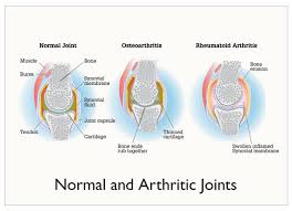 Osteoarthritis And Rheumatoid Arthritis 2012