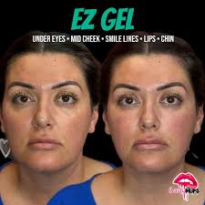 Last few days to grab this $500 PRF EZ Gel special! You deserve it, and so  do those tired eyes. 👀✨ Say hello to refreshed, youthful, glowing skin!