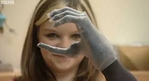 Girl, 15, Gets Bionic Fingers (VIDEO)