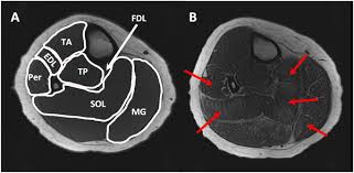 The muscles lie within a flat fascia on the dorsum of the foot (fascia dorsalis pedis) and are innervated by the deep fibular interestingly the dorsal foot muscles generally have no insertion at the little toe. Magnetic Resonance Assessment Of Hypertrophic And Pseudo Hypertrophic Changes In Lower Leg Muscles Of Boys With Duchenne Muscular Dystrophy And Their Relationship To Functional Measurements