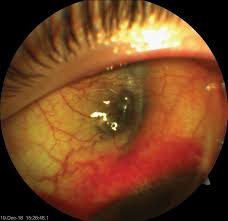 Image result for lesion sclera