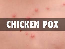 Menjadi sebuah keharusan bagi anda yang divonis menderita sebuah penyakit berat untuk melakukan diet atau menyeleksi asupan makanan dalam tubuh. Vaksin Chickenpox Tidak Bertanggungjawab Untuk Kebangkitan Dalam Kayu Kajian Kata Kanak Kanak Kesihatan 2021