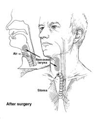 Sure everyone gets a sore throat at times, but how do you know you know your body better than anywhere, so if something feels serious then there is no point hoping it will go away. Throat Cancer Surgery What Is Surgery For Throat Cancer