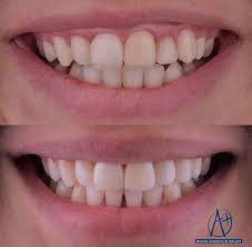 Dis Eti Duzeltimi Bleaching On 3 Dis Laminate Veneer Kuron Saglikli Gulusler Dileriz Aplusdental Gulustasarimi Estetikg Ortodonti Saglikli Dis Sagligi
