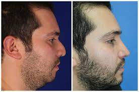 Bichectomia Antes Y Despues Hombres Bichectomia Anticipadamente Y Posteriormente