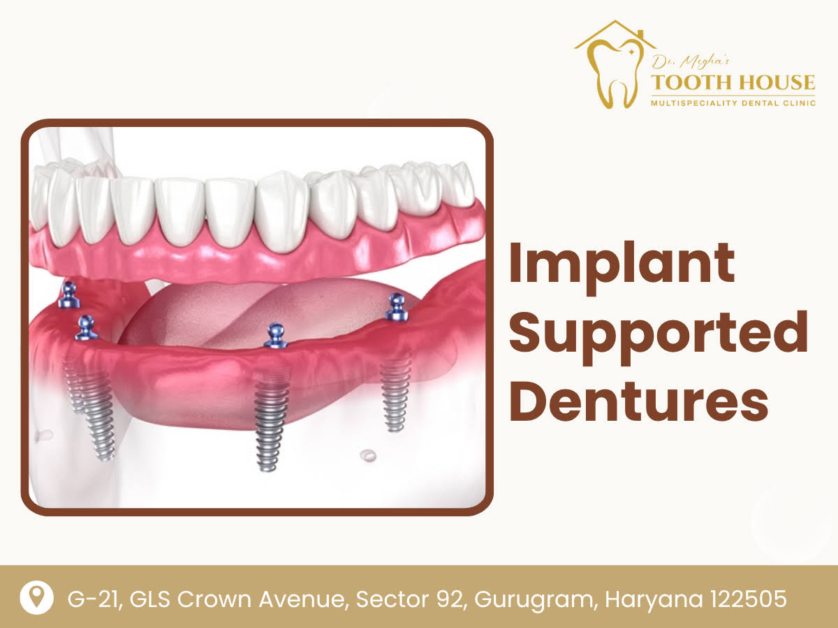 Implant Supported Dentures product image