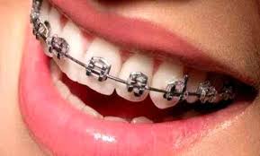 Behel (bracket) yang dipadukan dengan karet pengait bracket dengan kawat niti dengan berbagai macam pilihan motif dan warna. Ini Fungsinya Karet Behel Diganti Rutin Balipost Com