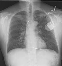 Published on september 29, 2014. Implantable Cardioverter Defibrillator Wikipedia