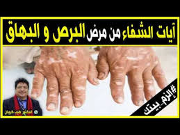 آيات الشفاء من مرض البرص بإذن الله مع الدكتور طيب كريبان Youtube