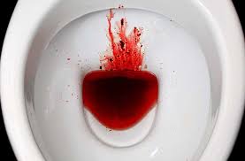 Image result for Blood in stool