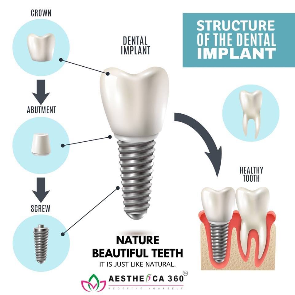 Dental Implant product image