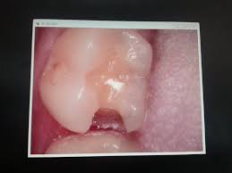 Fillings can take anywhere from a few minutes to about an hour. How Long Does It Take To Fill A Cavity Reddit Teethwalls