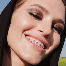 An Adult's Guide to Getting Braces