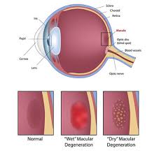Macular Degeneration Chart Eye Physicians Pc Nebraska