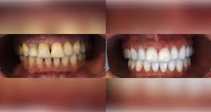 How long do veneers last? How Long Do Veneers Last Qunomedical