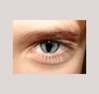 Синдром кошачьего глаза (Coloboma) — редкое и загадочное ...