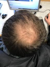 A receding hairline is a gradual process where the hairline moves back across the head, giving you the appearance of a higher forehead. Pattern Hair Loss Wikipedia