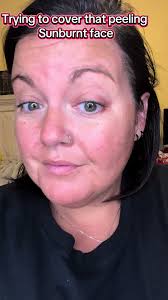 How to Cover Sunburn Peeling Patch with Makeup