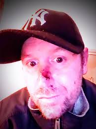 The Horrific Details Of My Most Painful Injury Ever