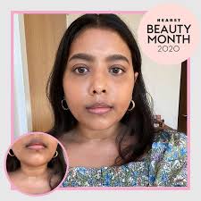 Image result for Melasma