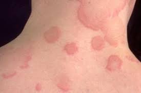 Hives that last over 6 weeks are called chronic hives. Iufyxe8m7b5bdm