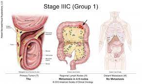 Cancer has been diagnosed, cancer has not spread and is very small. Colorectal Cancer Stages Cancer Net