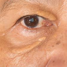 Image result for xanthelasma of eyelid