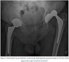 Image result for Hip Dislocation