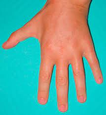 L hopital de la timone a laissé rentrer un malade atteint d une bronchite aigüe malgré sa maladie de charcot avec insuffisance respiratoire et ce week end vu que cela s aggravait les pompiers l ont transporté aux urgences. Correction D Une Amyotrophie De La Face Dorsale Des Mains D Origine Neurologique Par Autogreffe De Cellules Adipocytaires A Propos D Un Cas Original Sciencedirect