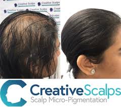 There are very few trichologists who can offer both experienced, qualified advice on hair loss treatments and scalp micropigmentation. Scalp Micropigmtation Long Hair Smp For Long Hair Creative Scalps