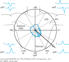 Graphic Representation Of Axis Deviation Cardiac Nursing