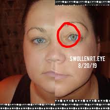 Does anyone else get intense skin pain with a low grade fever?