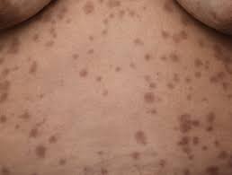 The symptoms of syphilis are not always obvious and may eventually disappear, but you'll usually remain. Syphilis Images Dermnet Nz