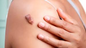 Tratamiento para eliminarlo