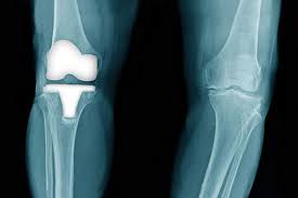 Although insurance for knee replacement surgery in india is offered by most providers, many that is the reason why it is recommended to buy health insurance after you reach the age of 30 years so coverage: Robot Assisted Knee Surgery Is It Worth The Cost