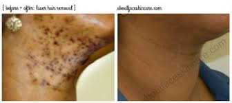 The procedure targets dark pigments in facial hair straight at the roots and damages them on contact. An Additional Benefit Of Laser Hair Removal No More Dark Spots From Past In Growns Philadelphia Candela Laserha Laser Hair Removal Laser Hair Hair Removal