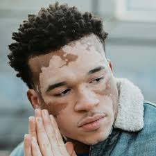 Image result for Vitiligo